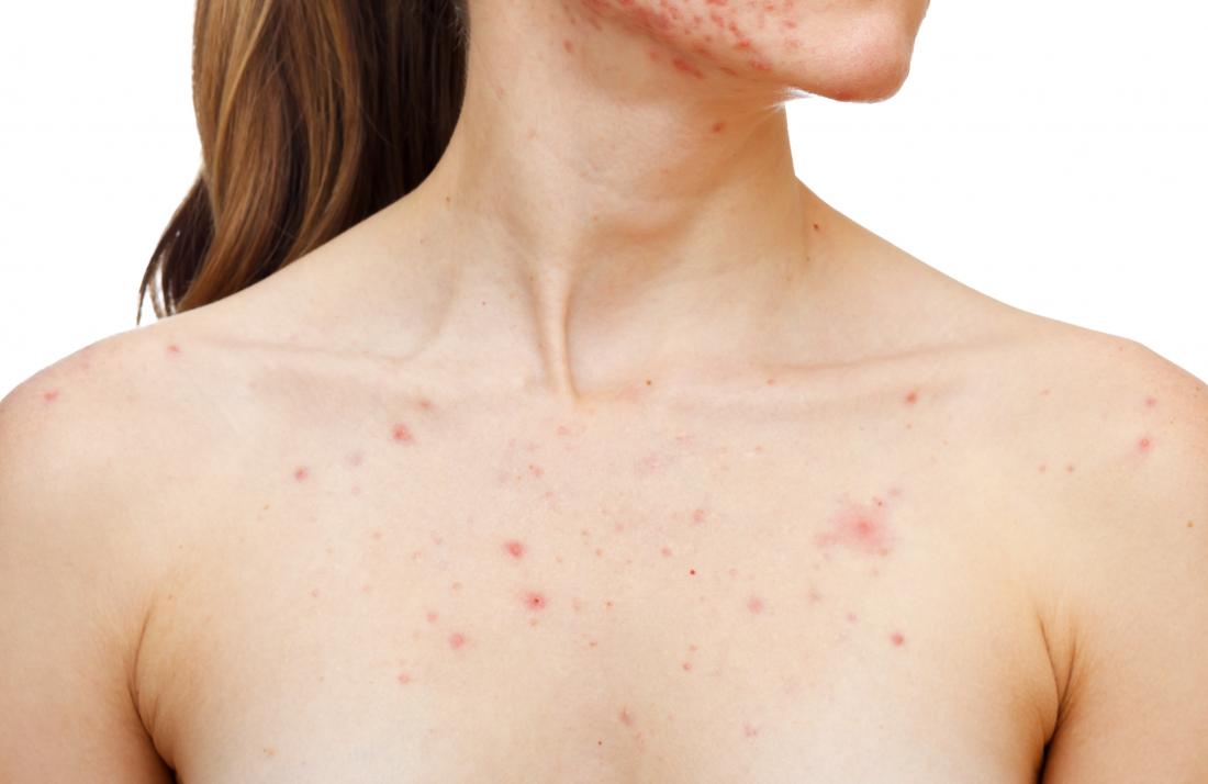 how to treat pimples-