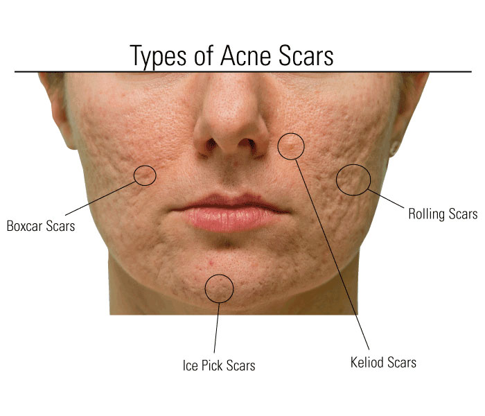 Types Of Acne Scars
